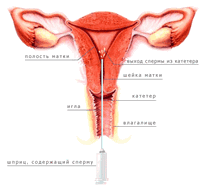Качество донорской спермы и шансы на беременность при ВМИ