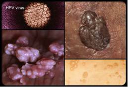 HPV és méhnyakrák | negerove.lt